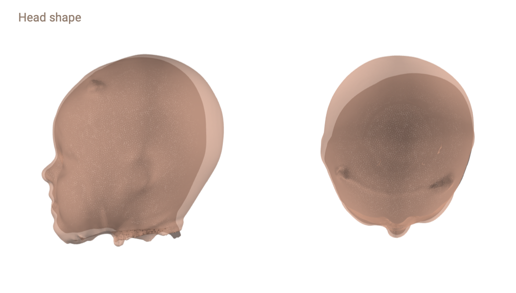 EinScan H2 Cranial Remolding Solutions