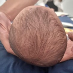 Plagiocephaly