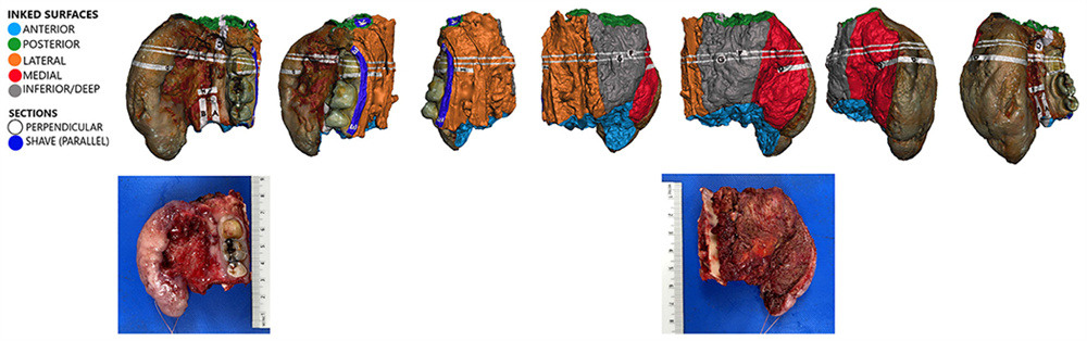 Postoperative virtual 3D specimen mapping results (CAD screen-captures, above; gross photographs, below)